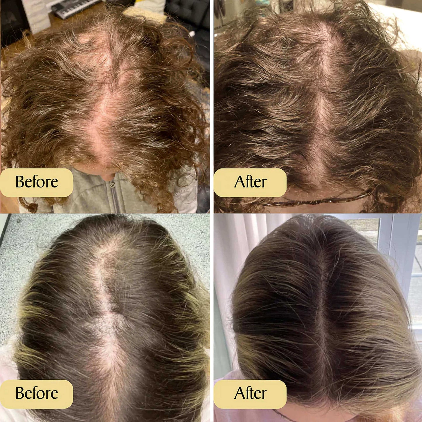 Carvenhy™ | The Ultimate Solution for Hair Regrowth